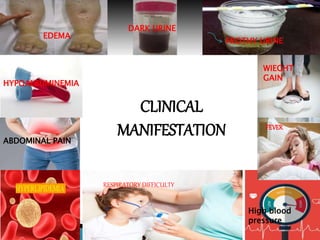 EDEMA
DARK URINE
FROTHY URINE
RESPIRATORY DIFFICULTY
ABDOMINAL PAIN
FEVER
WIEGHT
GAIN
HYPOALBUMINEMIA
High blood
pressure
CLINICAL
MANIFESTATION
 