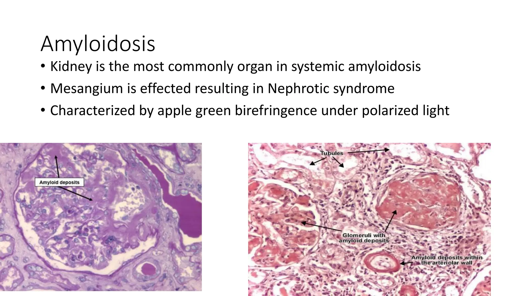 Amyloidosis
• Kidney is the most commonly organ in systemic amyloidosis
• Mesangium is effected resulting in Nephrotic syndrome
• Characterized by apple green birefringence under polarized light
 