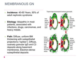 MEMBRANOUS GN 
 Incidence: 40-60 Years, 50% of 
adult nephrotic syndrome 
 Etiology: Idiopathic in most 
patients, associated with 
infections, drugs, carcinomas, and 
heavy metals. 
 Path: Diffuse, uniform BM 
thickening with subepithelial 
projections (“spikes”). Diffuse, 
coarsely granular IgG and C3 
deposits along basement 
membranes. Electron-dense 
subepithelial deposits 
 
