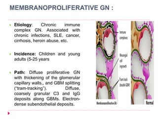 MEMBRANOPROLIFERATIVE GN : 
 Etiology: Chronic immune 
complex GN. Associated with 
chronic infections, SLE, cancer, 
cirrhosis, heroin abuse, etc. 
 Incidence: Children and young 
adults (5-25 years 
 Path: Diffuse proliferative GN 
with thickening of the glomerular 
capillary walls,, and GBM splitting 
(“tram-tracking”). Diffuse, 
coarsely granular C3 and IgG 
deposits along GBMs. Electron-dense 
subendothelial deposits. 
 