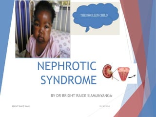 NEPHROTIC
SYNDROME
BY DR BRIGHT RAICE SIAMUNYANGA
12/30/2018BRIGHT RAICE SIAMS
 
