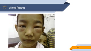 Clinical features
11.
▰.
 