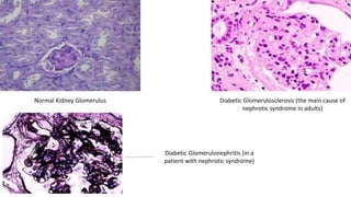 Normal Kidney Glomerulus Diabetic Glomerulosclerosis (the main cause of
nephrotic syndrome in adults)
Diabetic Glomerulonephritis (in a
patient with nephrotic syndrome)
 