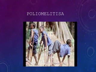 POLIOMELITISA
 