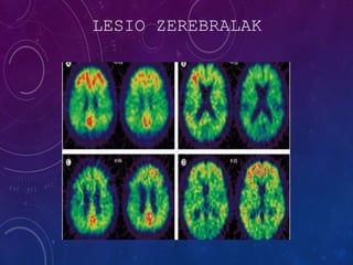 LESIO ZEREBRALAK
 