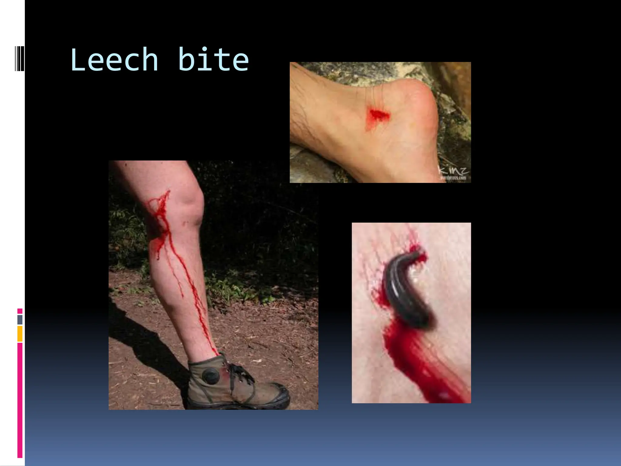 Leech bite
 