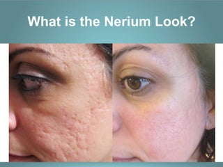 What is the Nerium Look?
 