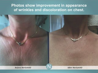Photos show improvement in appearance
of wrinkles and discoloration on chest.

 