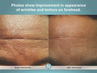 Photos show improvement in appearance
of wrinkles and texture on forehead.

 