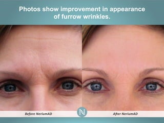 Photos show improvement in appearance
of furrow wrinkles.

 