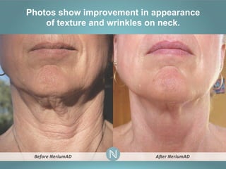 Photos show improvement in appearance
of texture and wrinkles on neck.

 