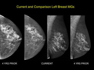 Current and Comparison Left Breast MGs




4 YRS PRIOR               CURRENT              4 YRS PRIOR
 