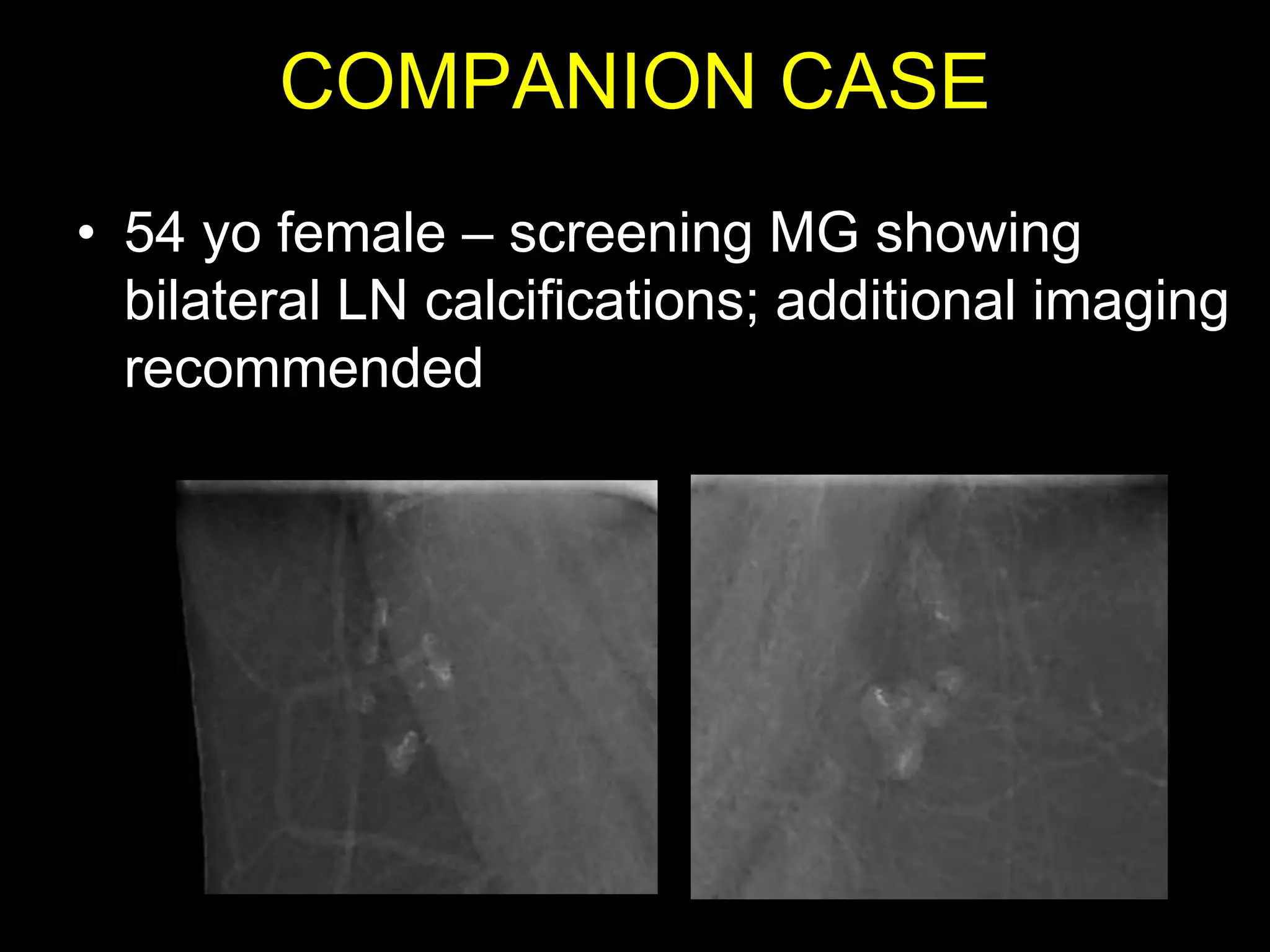 COMPANION CASE
• 54 yo female – screening MG showing
  bilateral LN calcifications; additional imaging
  recommended
 