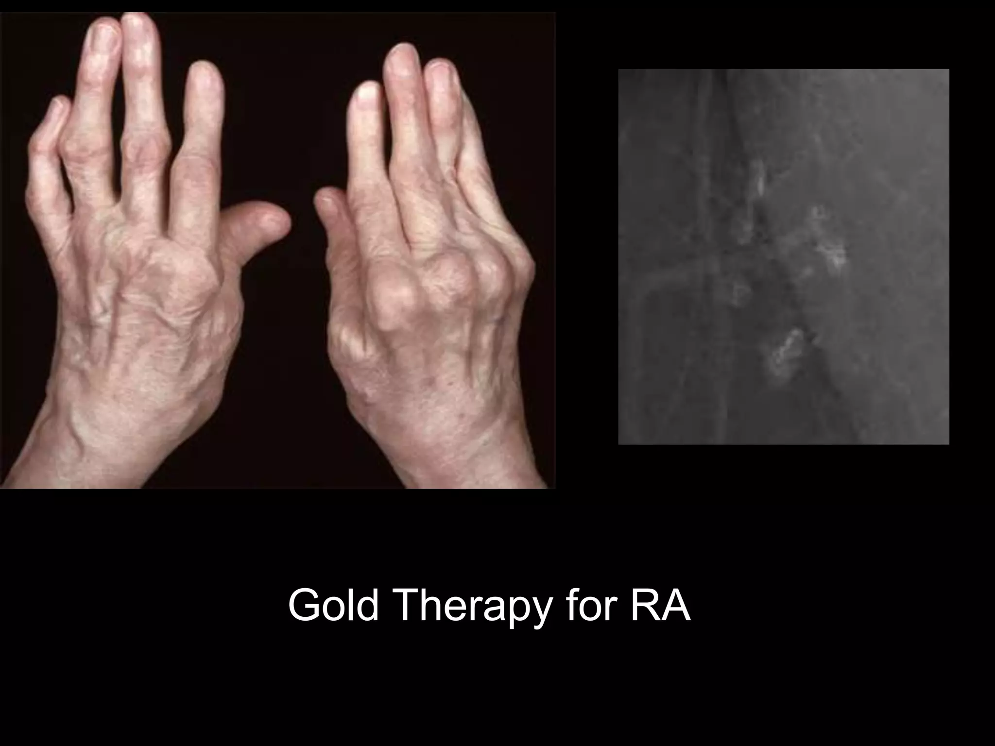 Gold Therapy for RA
 
