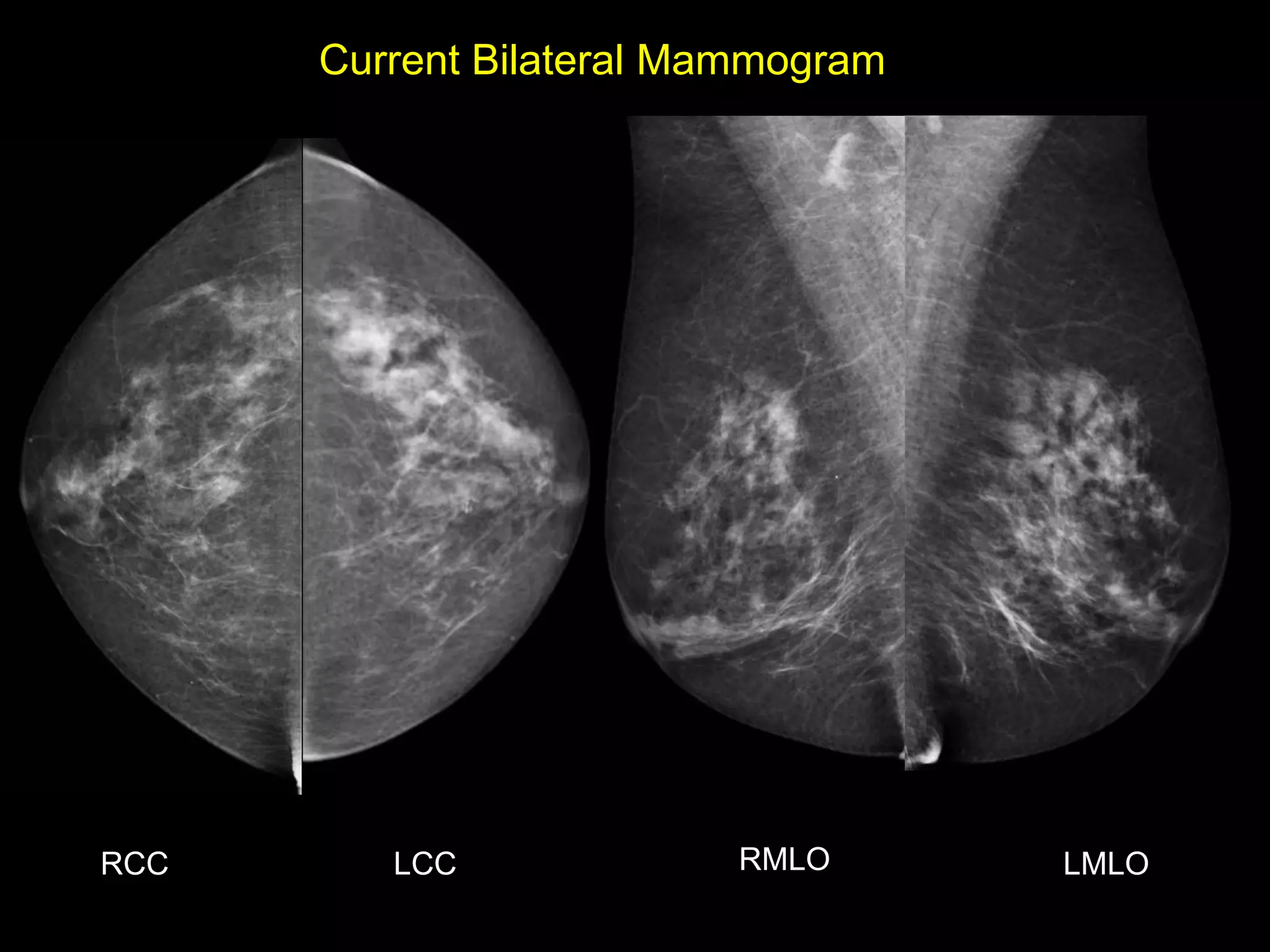 Current Bilateral Mammogram




RCC      LCC             RMLO       LMLO
 