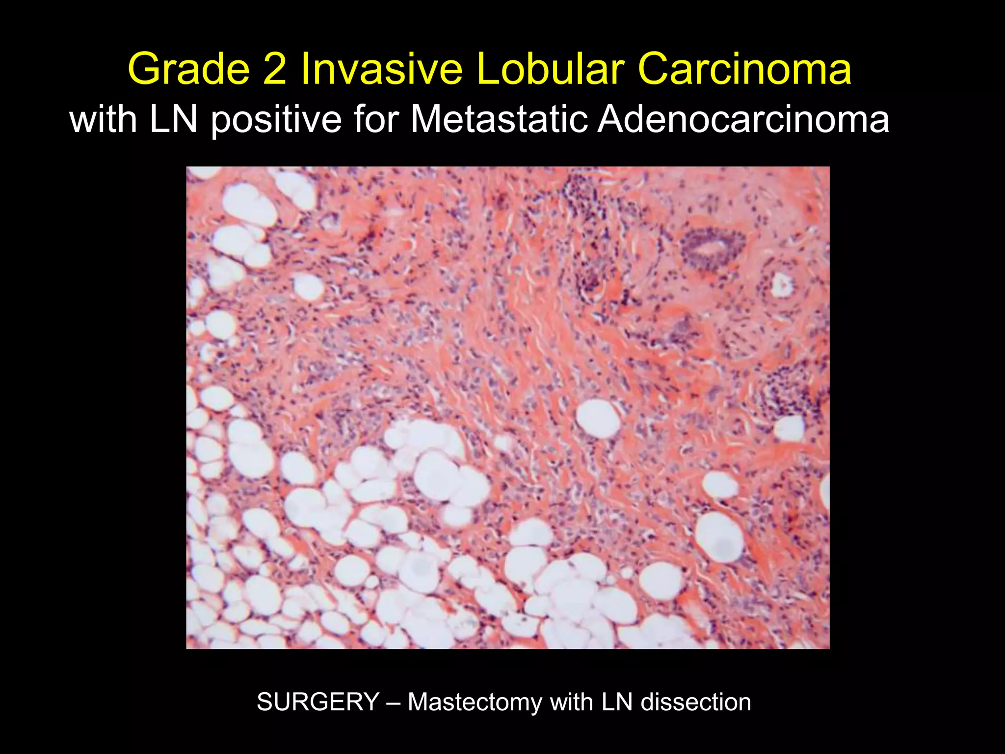 Grade 2 Invasive Lobular Carcinoma
with LN positive for Metastatic Adenocarcinoma




          SURGERY – Mastectomy with LN dissection
 