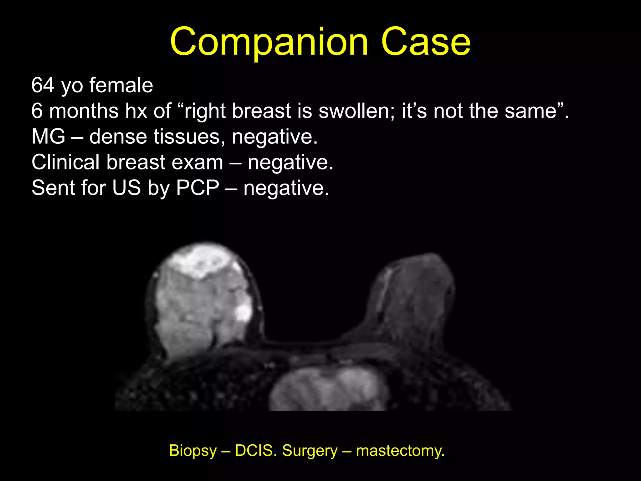 Companion Case
64 yo female
6 months hx of “right breast is swollen; it‟s not the same”.
MG – dense tissues, negative.
Clinical breast exam – negative.
Sent for US by PCP – negative.




               Biopsy – DCIS. Surgery – mastectomy.
 
