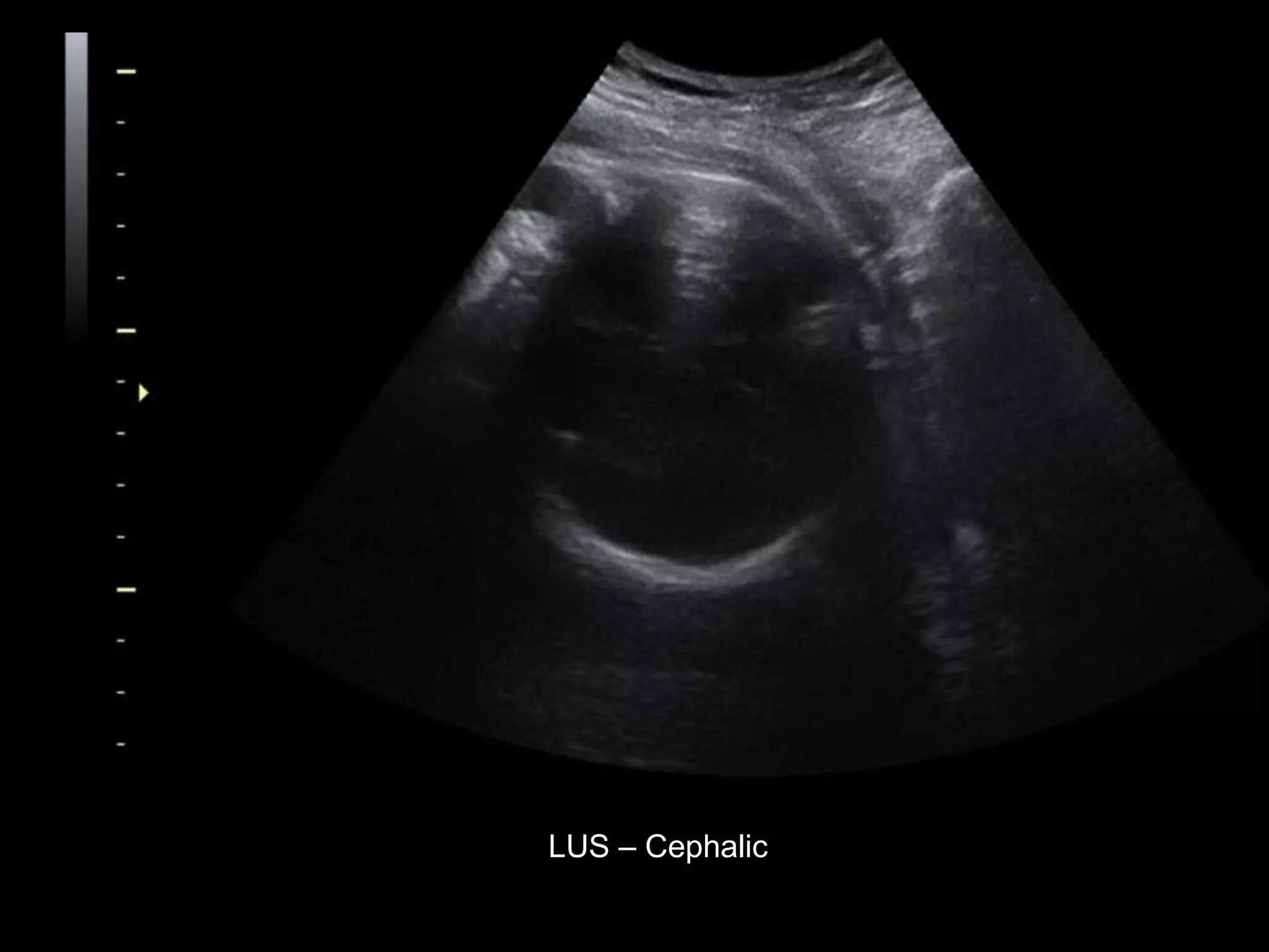 LUS – Cephalic
 