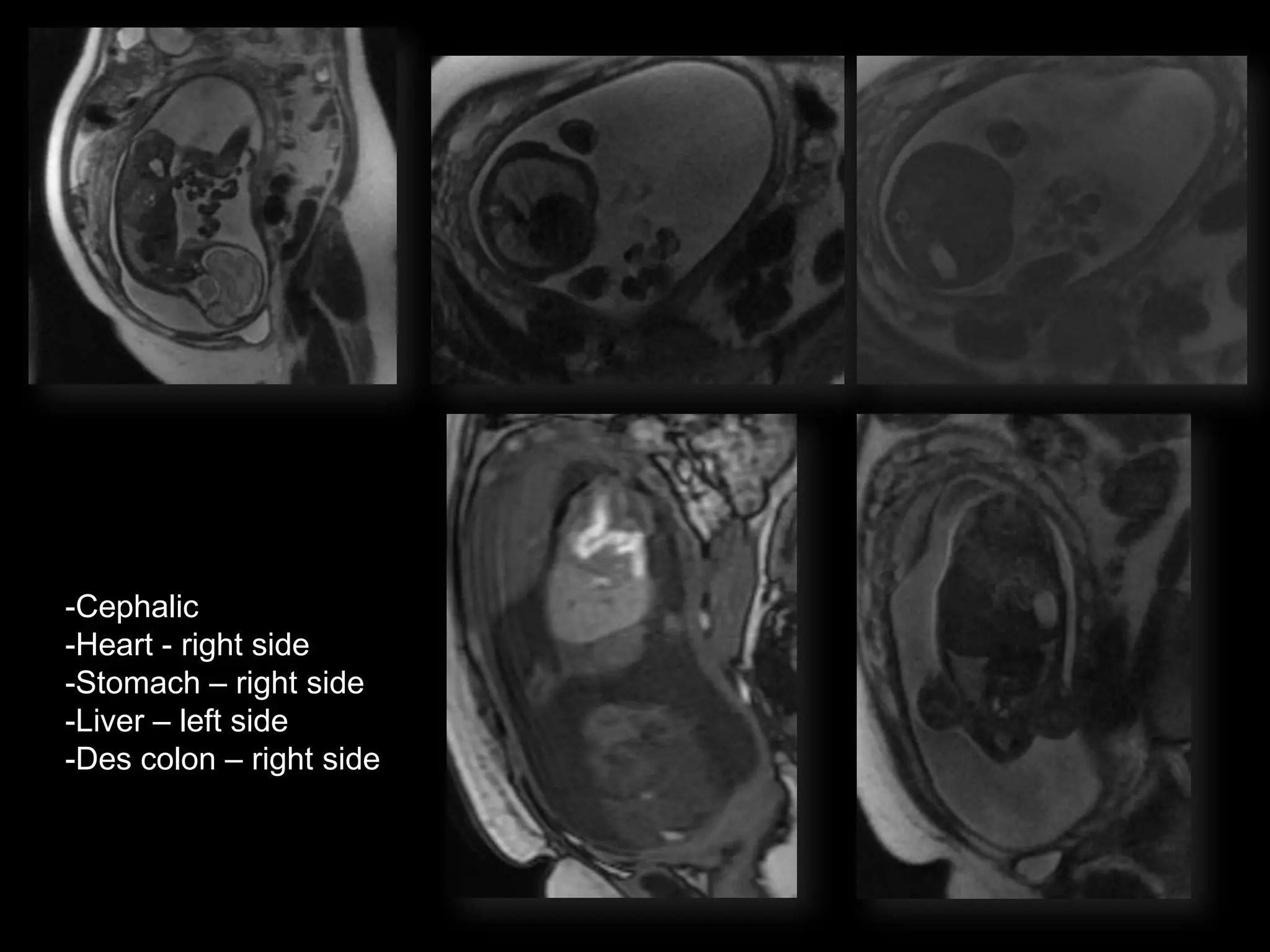 -Cephalic
-Heart - right side
-Stomach – right side
-Liver – left side
-Des colon – right side
 
