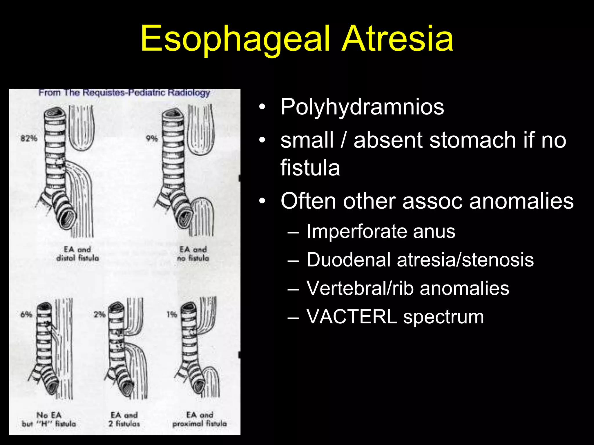Esophageal Atresia
      • Polyhydramnios
      • small / absent stomach if no
        fistula
      • Often other assoc anomalies
        –   Imperforate anus
        –   Duodenal atresia/stenosis
        –   Vertebral/rib anomalies
        –   VACTERL spectrum
 