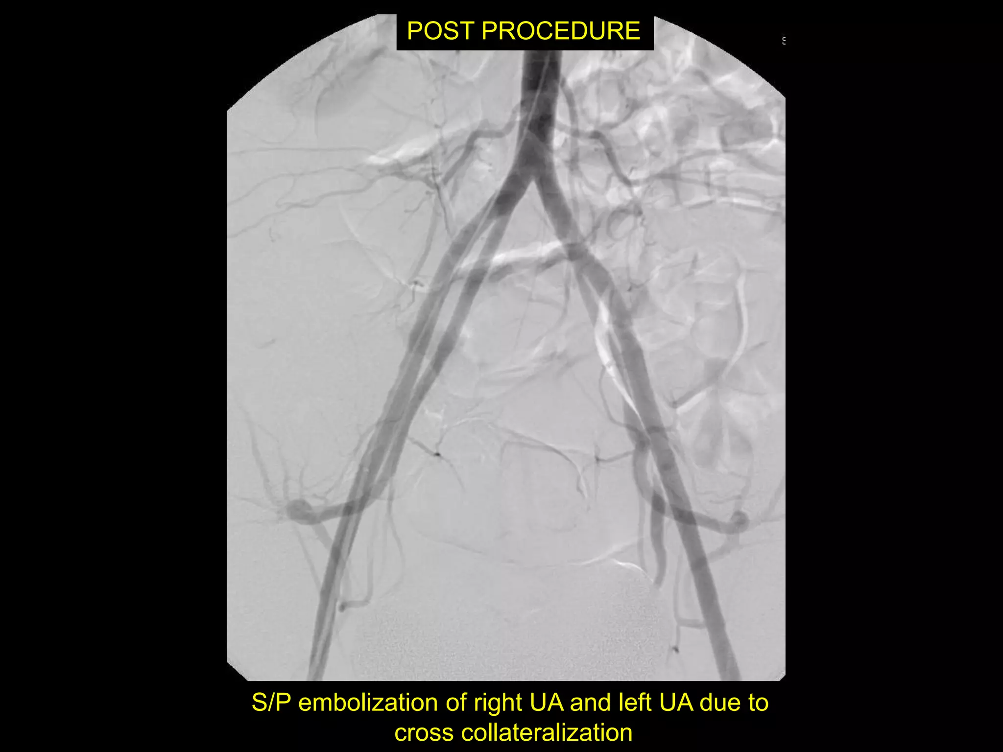 POST PROCEDURE




S/P embolization of right UA and left UA due to
            cross collateralization
 