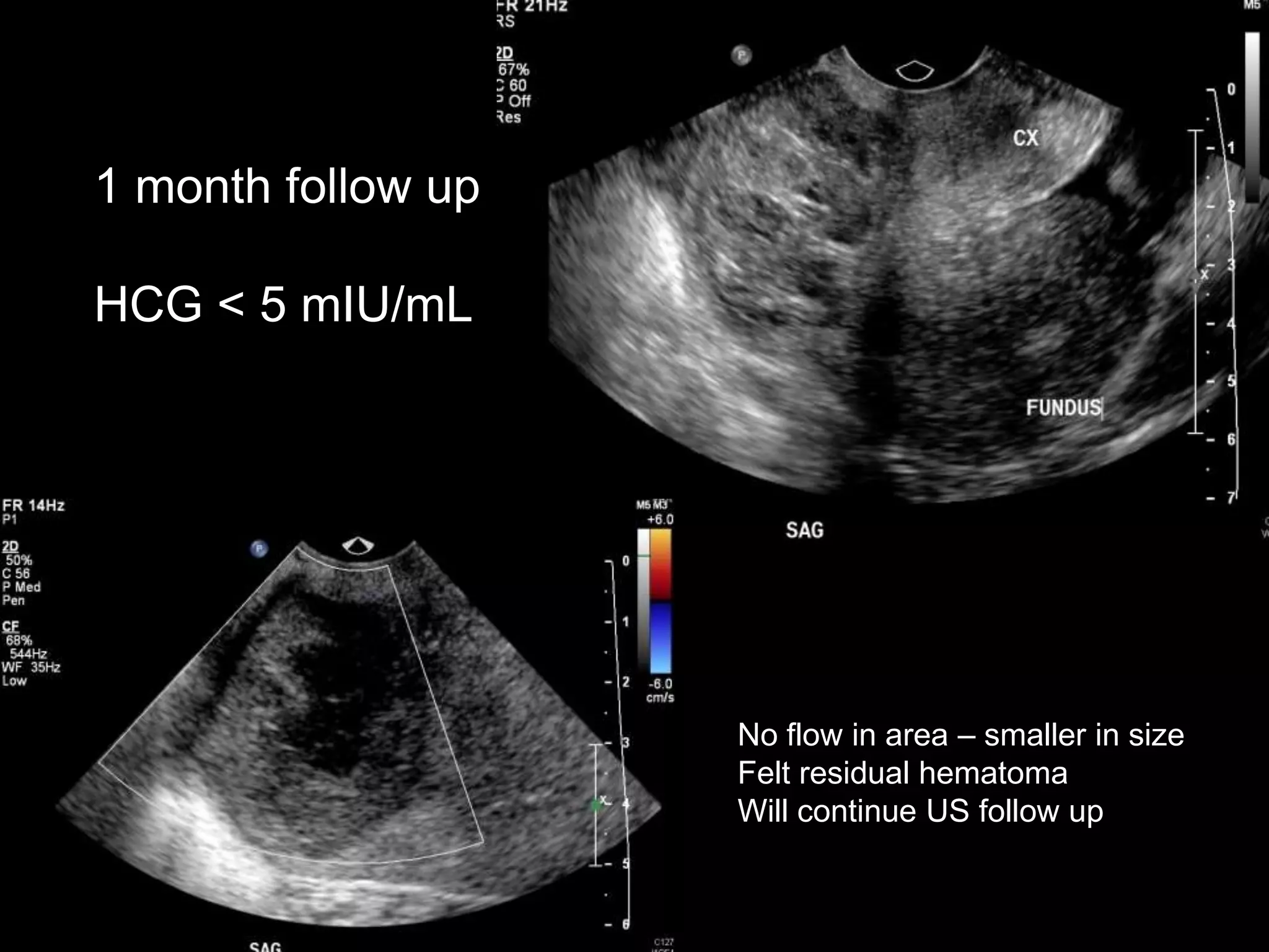 1 month follow up

HCG < 5 mIU/mL




                    No flow in area – smaller in size
                    Felt residual hematoma
                    Will continue US follow up
 