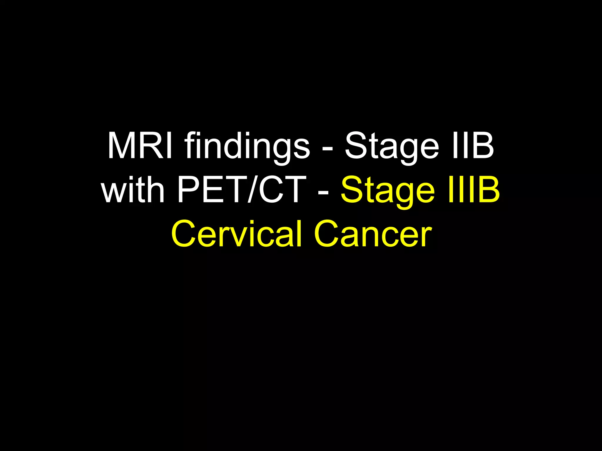 MRI findings - Stage IIB
with PET/CT - Stage IIIB
    Cervical Cancer
 