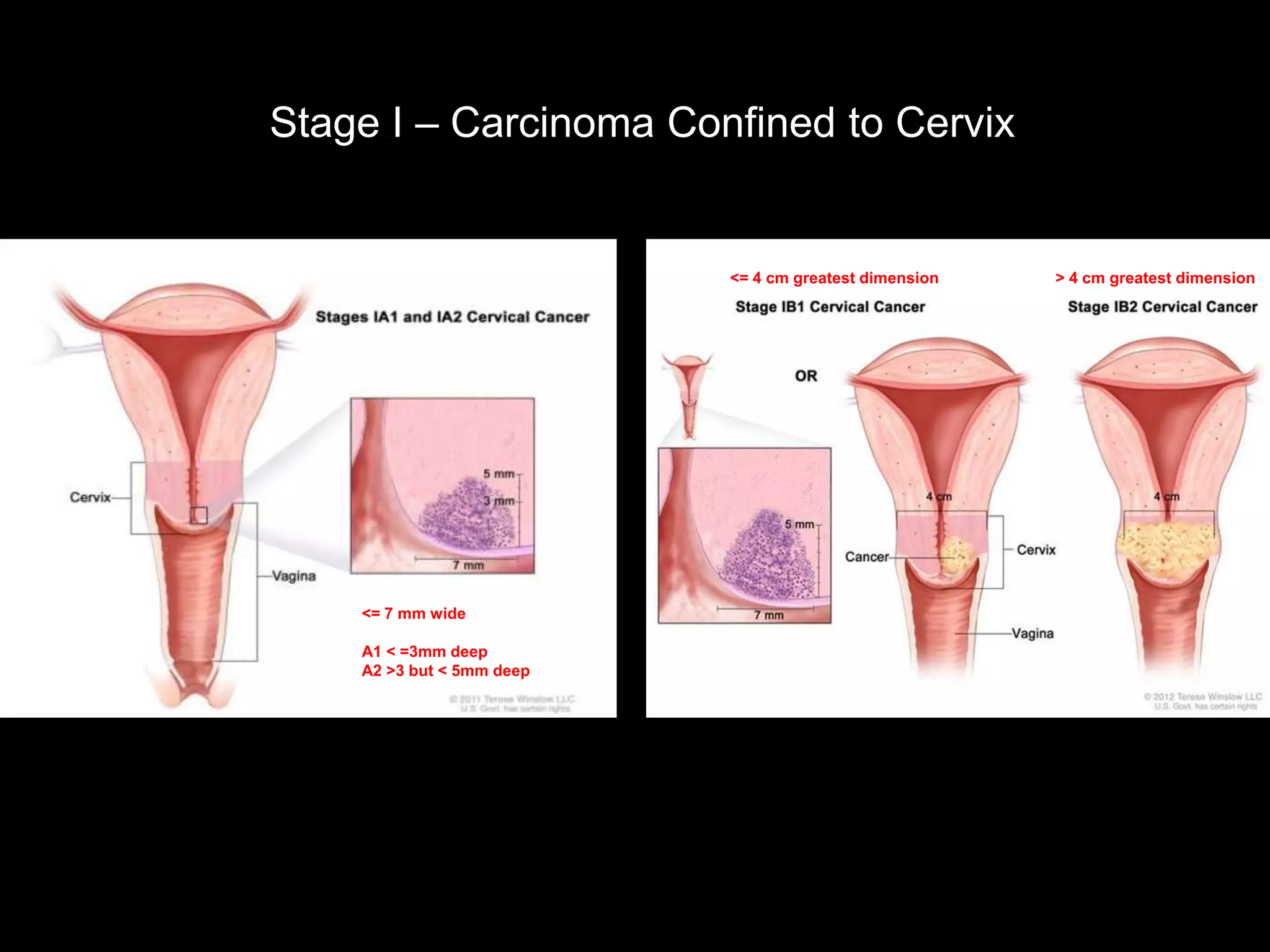 Stage I – Carcinoma Confined to Cervix


                           <= 4 cm greatest dimension   > 4 cm greatest dimension




    <= 7 mm wide

    A1 < =3mm deep
    A2 >3 but < 5mm deep
 