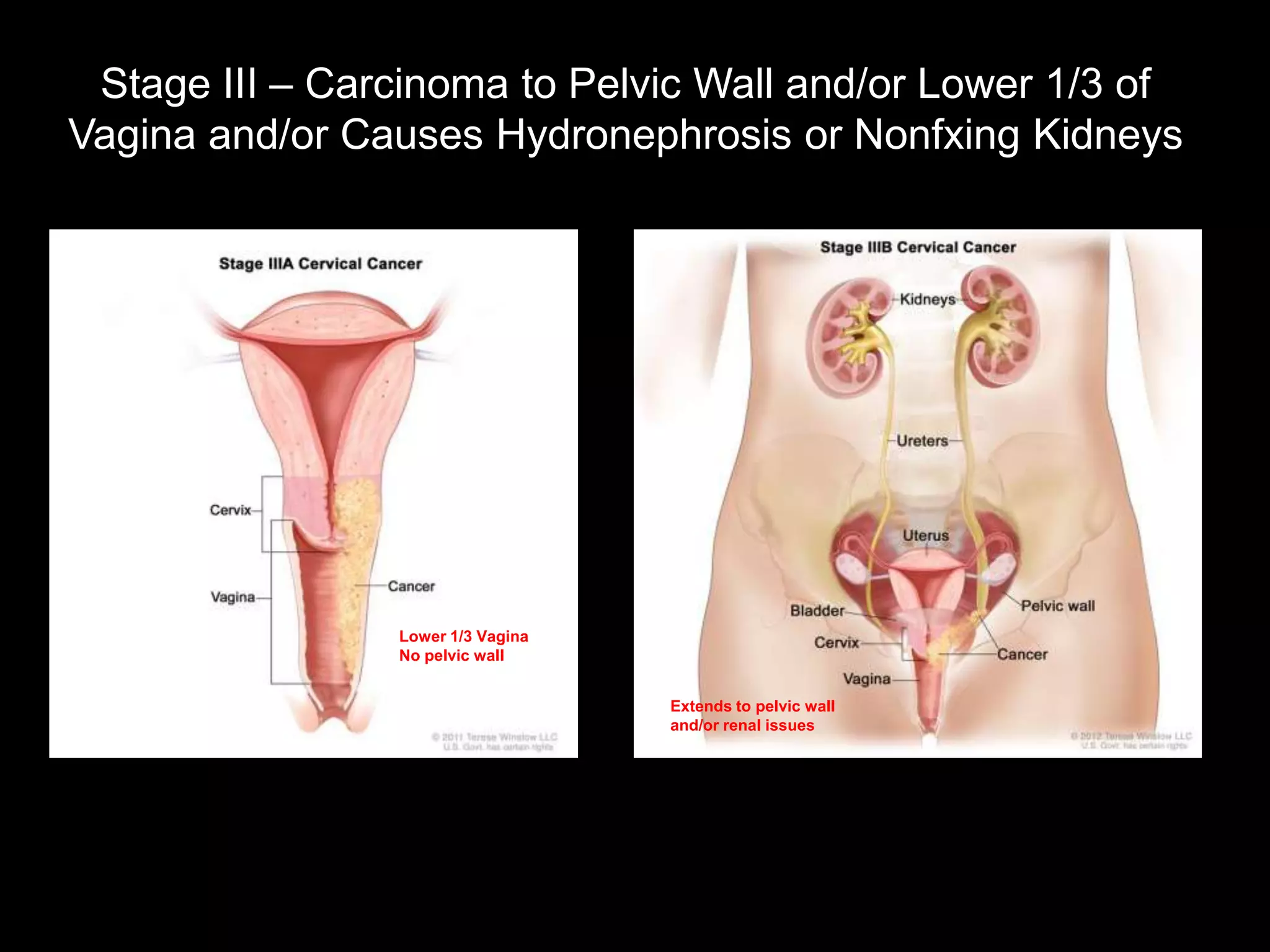 Stage III – Carcinoma to Pelvic Wall and/or Lower 1/3 of
Vagina and/or Causes Hydronephrosis or Nonfxing Kidneys




                Lower 1/3 Vagina
                No pelvic wall


                                   Extends to pelvic wall
                                   and/or renal issues
 