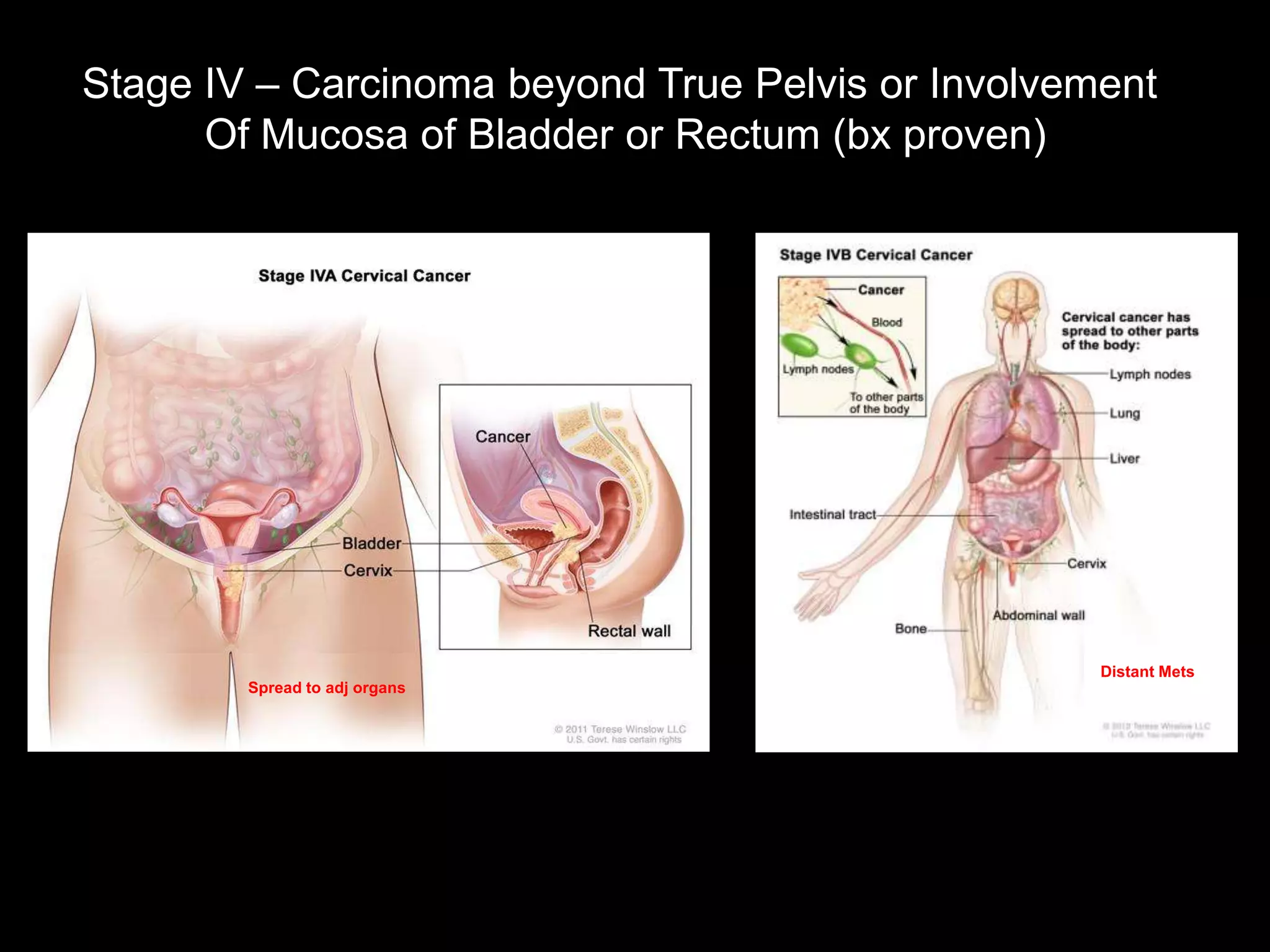 Stage IV – Carcinoma beyond True Pelvis or Involvement
      Of Mucosa of Bladder or Rectum (bx proven)




                                                   Distant Mets
        Spread to adj organs
 
