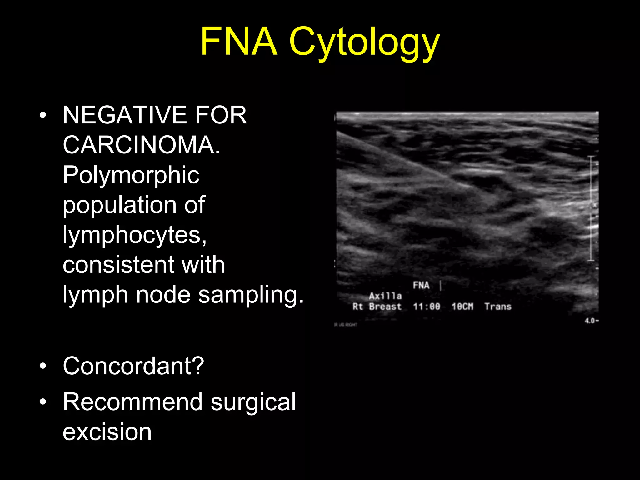 FNA Cytology
• NEGATIVE FOR
  CARCINOMA.
  Polymorphic
  population of
  lymphocytes,
  consistent with
  lymph node sampling.

• Concordant?
• Recommend surgical
  excision
 