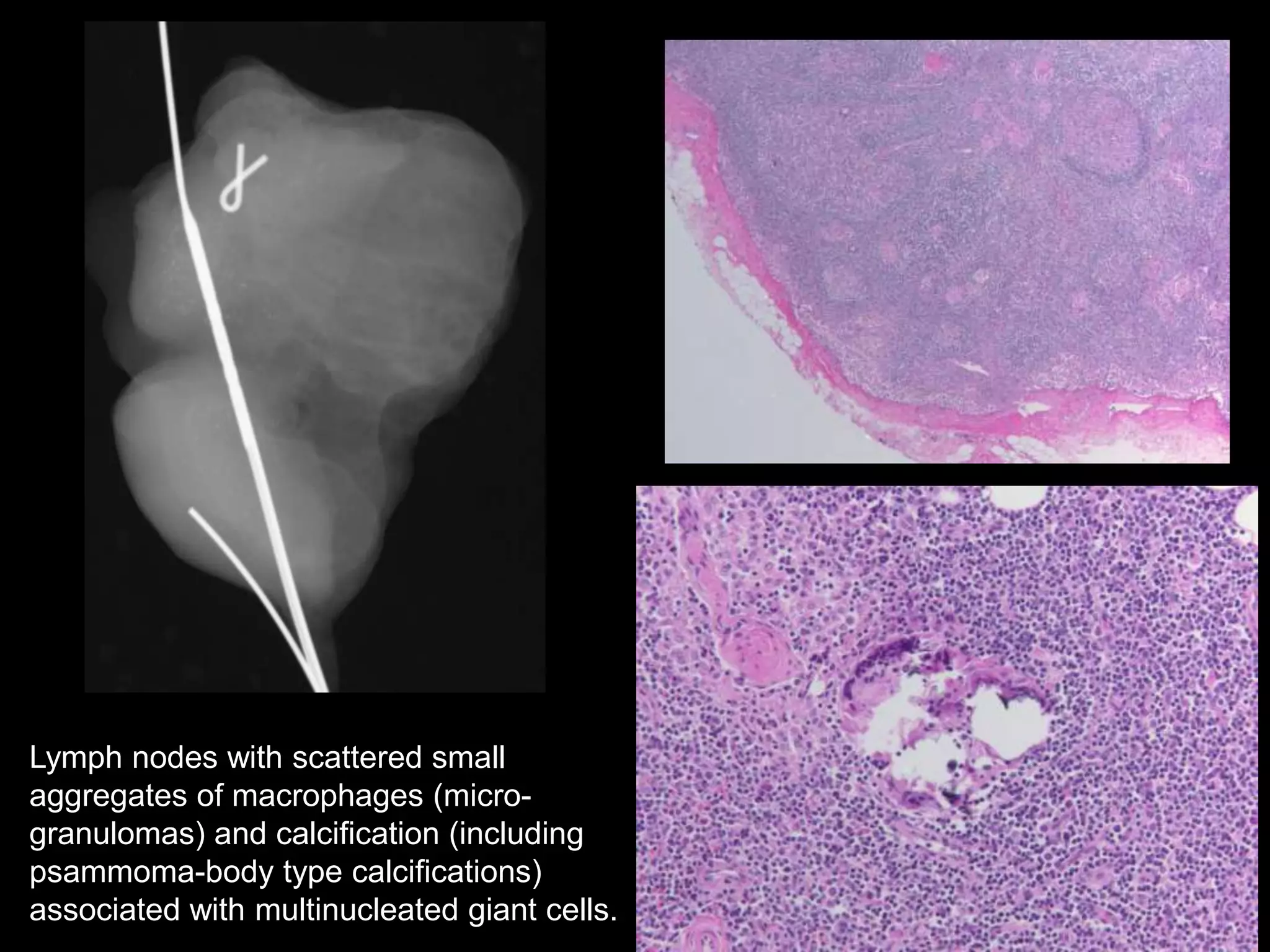 Lymph nodes with scattered small
aggregates of macrophages (micro-
granulomas) and calcification (including
psammoma-body type calcifications)
associated with multinucleated giant cells.
 