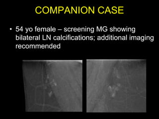 COMPANION CASE
• 54 yo female – screening MG showing
  bilateral LN calcifications; additional imaging
  recommended
 