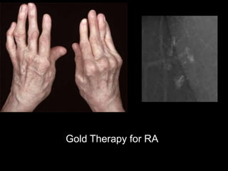Gold Therapy for RA
 