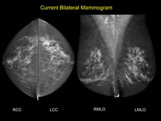 Current Bilateral Mammogram




RCC      LCC             RMLO       LMLO
 