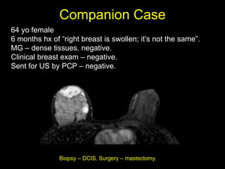 Companion Case
64 yo female
6 months hx of “right breast is swollen; it‟s not the same”.
MG – dense tissues, negative.
Clinical breast exam – negative.
Sent for US by PCP – negative.




               Biopsy – DCIS. Surgery – mastectomy.
 