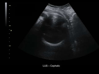 LUS – Cephalic
 