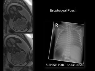 Esophageal Pouch
 