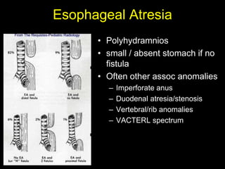 Esophageal Atresia
      • Polyhydramnios
      • small / absent stomach if no
        fistula
      • Often other assoc anomalies
        –   Imperforate anus
        –   Duodenal atresia/stenosis
        –   Vertebral/rib anomalies
        –   VACTERL spectrum
 