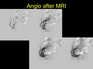 Angio after MRI
 