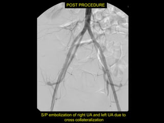 POST PROCEDURE




S/P embolization of right UA and left UA due to
            cross collateralization
 