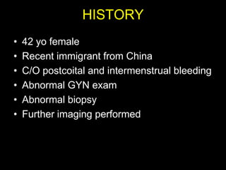 HISTORY
•   42 yo female
•   Recent immigrant from China
•   C/O postcoital and intermenstrual bleeding
•   Abnormal GYN exam
•   Abnormal biopsy
•   Further imaging performed
 