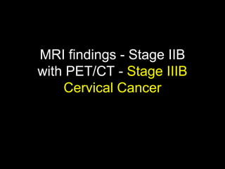 MRI findings - Stage IIB
with PET/CT - Stage IIIB
    Cervical Cancer
 