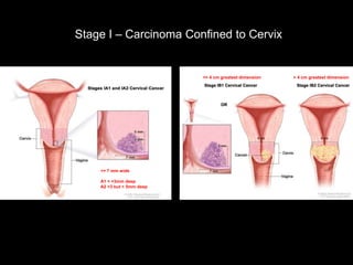 Stage I – Carcinoma Confined to Cervix


                           <= 4 cm greatest dimension   > 4 cm greatest dimension




    <= 7 mm wide

    A1 < =3mm deep
    A2 >3 but < 5mm deep
 