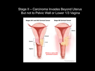 Stage II – Carcinoma Invades Beyond Uterus
  But not to Pelvic Wall or Lower 1/3 Vagina




                  With(A) or without (B)
                   parametrial invasion
 