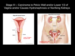 Stage III – Carcinoma to Pelvic Wall and/or Lower 1/3 of
Vagina and/or Causes Hydronephrosis or Nonfxing Kidneys




                Lower 1/3 Vagina
                No pelvic wall


                                   Extends to pelvic wall
                                   and/or renal issues
 