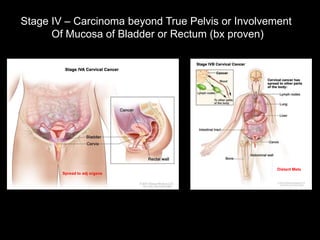 Stage IV – Carcinoma beyond True Pelvis or Involvement
      Of Mucosa of Bladder or Rectum (bx proven)




                                                   Distant Mets
        Spread to adj organs
 