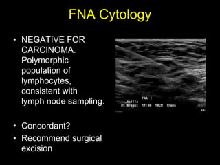 FNA Cytology
• NEGATIVE FOR
  CARCINOMA.
  Polymorphic
  population of
  lymphocytes,
  consistent with
  lymph node sampling.

• Concordant?
• Recommend surgical
  excision
 