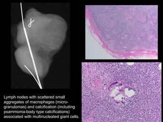 Lymph nodes with scattered small
aggregates of macrophages (micro-
granulomas) and calcification (including
psammoma-body type calcifications)
associated with multinucleated giant cells.
 