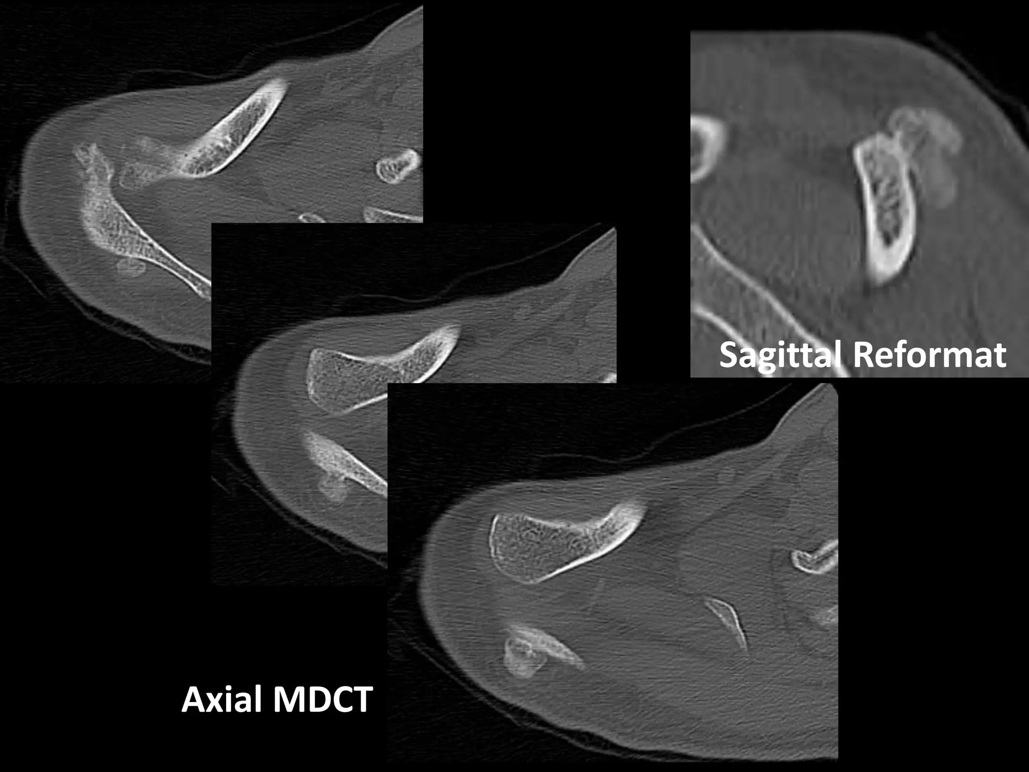 Sagittal Reformat
Axial MDCT
 